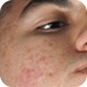 Spots and Acne